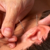 Ear acupuncture